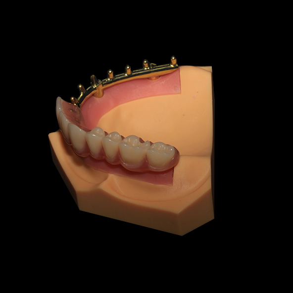 Dental Implant Laboratory | Class 3 Milled Titanium Bar All On X Dental Lmplants With Full Acrylic Denture