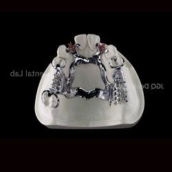 3D Printing Titanium Dental Framework for Customized Removable Dentures