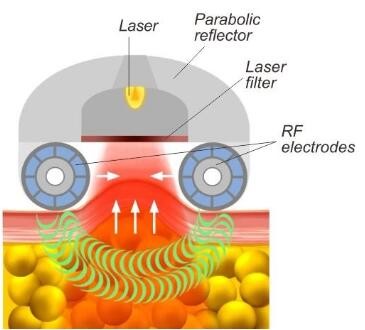Тело ультразвука уменьшая потерю веса воздушного давления ролика вакуума машины 40к