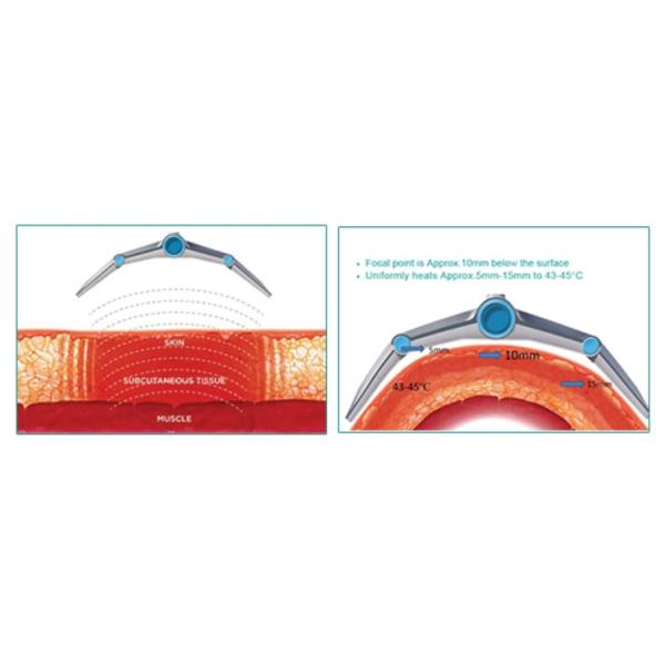 Contactless RF Slimming Machine For Fat Reduction