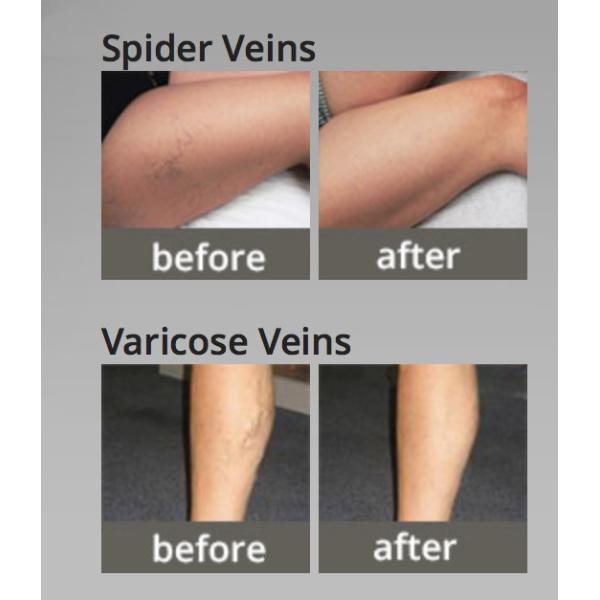 high power 980nm diode laser Vascular Removal