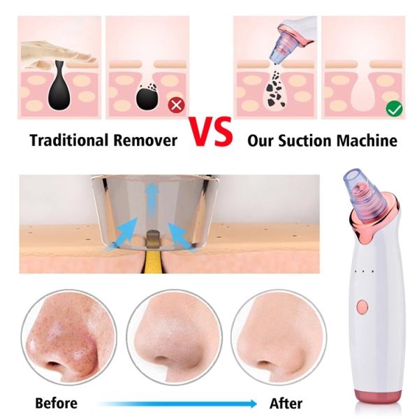 Powerful 53KPa Suction Acne Facial Pore Cleaner Comedo Suction for Smooth Complexion
