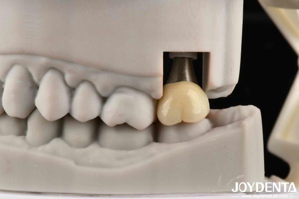 Biocompatible Dental Implant Crown And Bridge Aesthetically Pleasing For Safe Oral