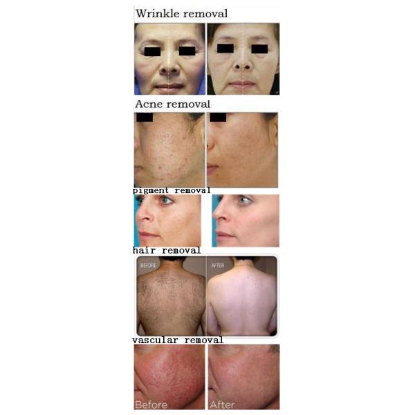 High quality&Factory price!! 2016 Hot ipl hair removal machine/fast permanent shr