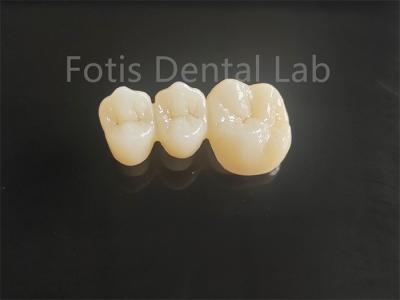High Strength Porcelain Layered Zirconia For Long Lasting Dental Bridges