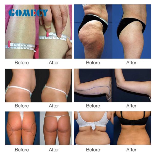 Anti Cellulite Microvibration Inner Balls Roller Therapy Machine For Body Slimming Weight Loss Face Skin Tightening