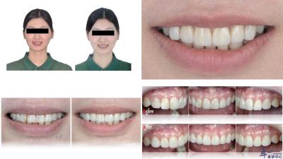 Joydentalab's popular products: Simulated aesthetic veneers