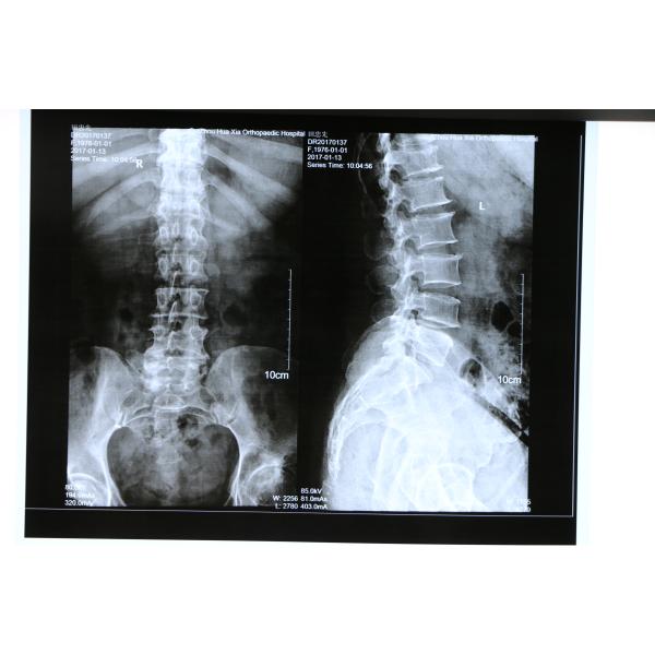 8x10 Inch 14x17 Inch Medical X Ray Film MRI PET CT Scan Films