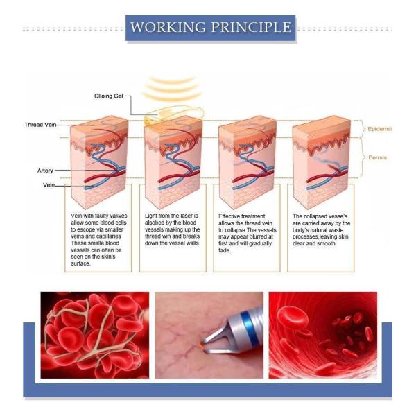 машина удаления Varicose вены удаления кровеносных сосудов лазерного диода 30w 980 васкулярная