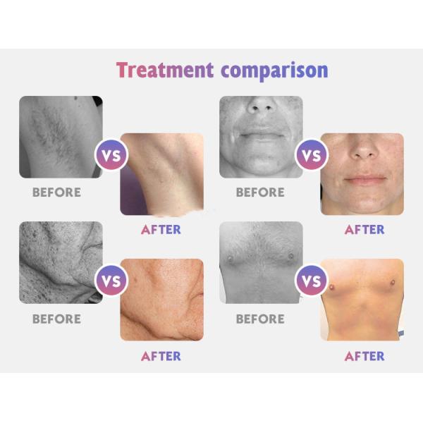 Shr Intense Pulsed Laser Hair Removal Machine 2000W Anti Puffiness