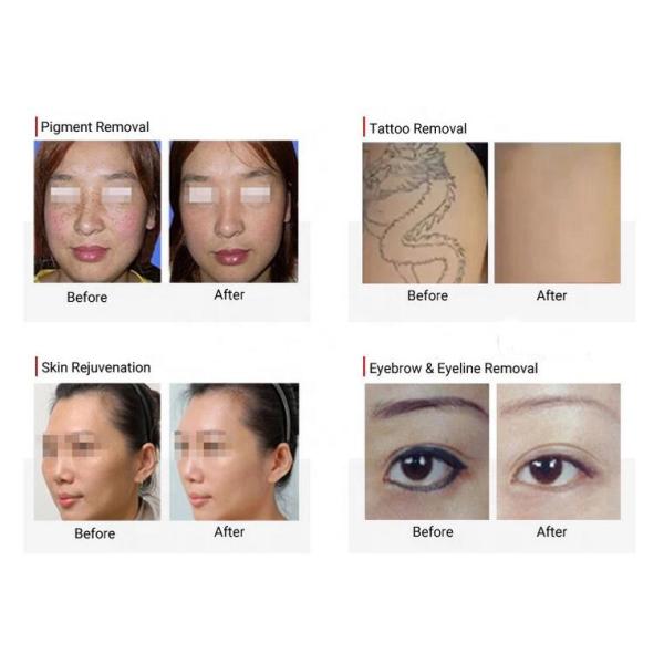 Portable Picosure Laser Machine Multi Functional Red Or Gray Color Optional