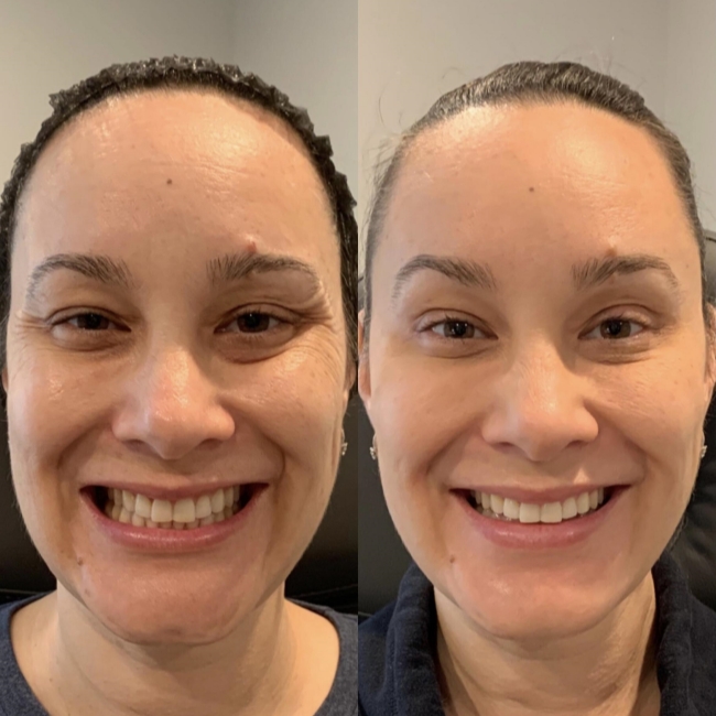 2 мл липового наполнителя для лица Juvederm Гиалуроновая кислота