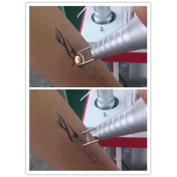 Popular ND yag tattoo machine q-switched nd yag laser tattoo removal machine