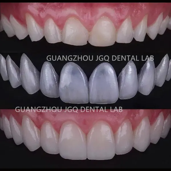 E.max All Ceramic Dental High Translucency China Dental Lab