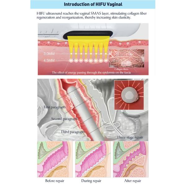 Skin Tightening Machine 2 In 1 Hifu Vaginal Tightening Face Lift Wrinkle Removal