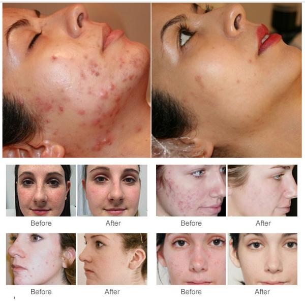 Hot Selling 8 Head Facial Beauty Machines Professional Portable Oxygen Facial Machine