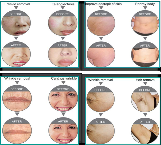 Pains Free  SHR Hair Removal Devices , Skin Rejuvenation Machine Med-140c+