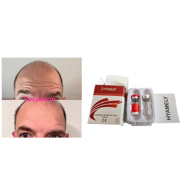 Hyamely 100 Unidades Toxina Botulínica Anti-Rugas Novo Produto Injecção de Botox