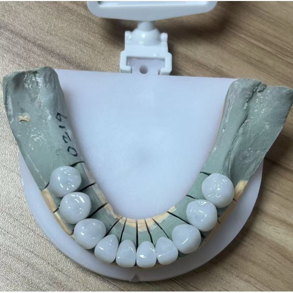 Full Zirconia dental bridge for high strength and durable dental restoration