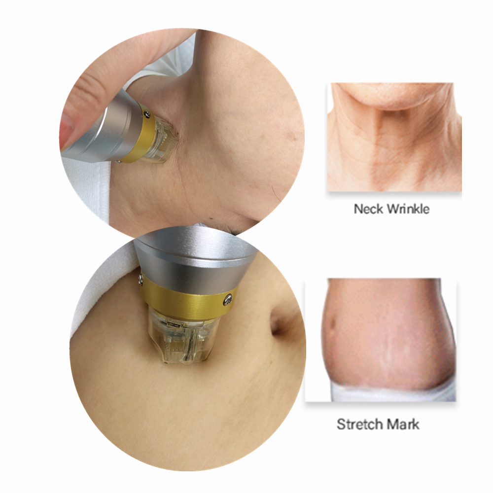Кожа Resurfacing частичная машина RF Microneedle с холодной терапией инвазионной