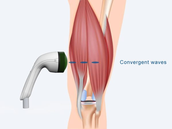 Focus Shockwave Softwave Tissue Cellsonic Regeneration Shock Wave Machine
