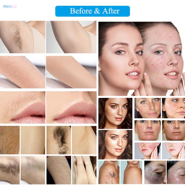 1064nm Fiber Optic Alex Laser Hair Removal Machine 8mm Spot Adjustable