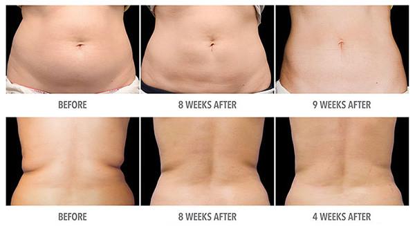 Non Surgical Cryolipolysis Slimming Machine / Cryo Weight Loss Equipment For salon use