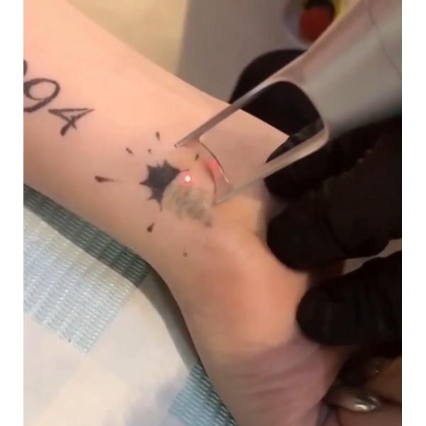 10Hz Frequency Laser Tattoo Removal Machine Q Switched Nd Yag Picosecond Pigment Treatment