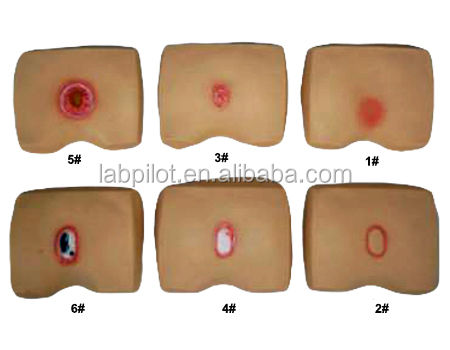 Decubitus Illness Evolution Models for Hospitals Streamlining Pressure Ulcers Nursing