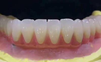 Customized Dental Zirconia Tooth Crown Stain Resistant With High Precision