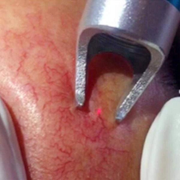 A aranha médica da máquina da beleza do laser de 980 diodos do Ce veia a remoção vascular 15w/20w/30w