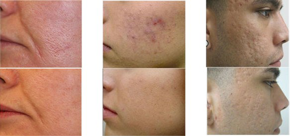 New Arrivals! Micro ultra Face Lift Scarlet RF Needle Machine Fractional RF Microneedle