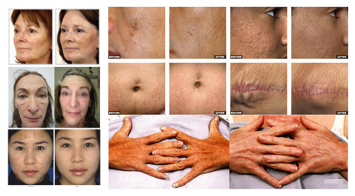 Factory price scar removal skin tighten Fractional Laser Co2 / CO2 fractional laser/ fractional co2 laser machine