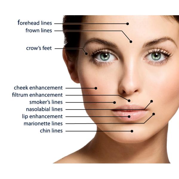 2 мл Juvederm кожный наполнитель для увеличения подбородка гиалуроновая кислота наполнители для носа 24 мг / мл