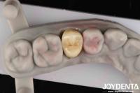 Fracture Toughness 9 MPa·m1/2 High Aesthetics High Resistance To Wear Full Zirconia
