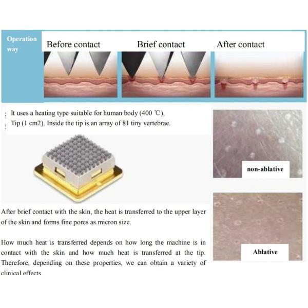 Утверждение ISO CE удаления пигмента машины RF Microneedling 50000 съемок