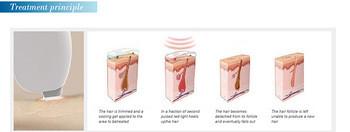 Medical Laser  triple wave germany technology vertical cold laser diode laser 755 808 1064  for clinic use