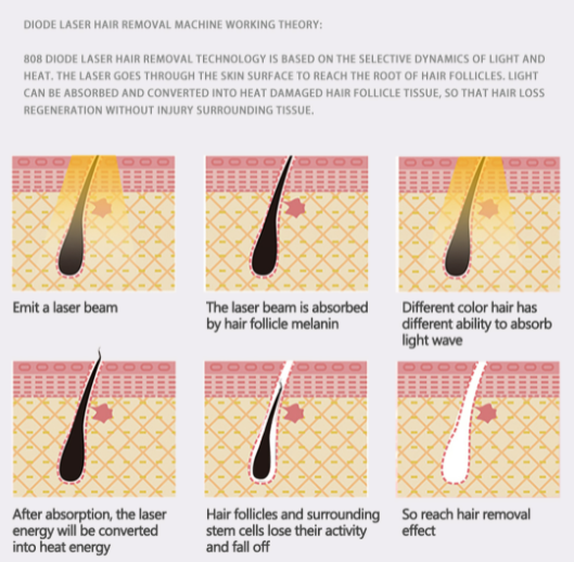 10 Bars Diode Laser Hair Removal Machine With Cooling 10 Million Shots