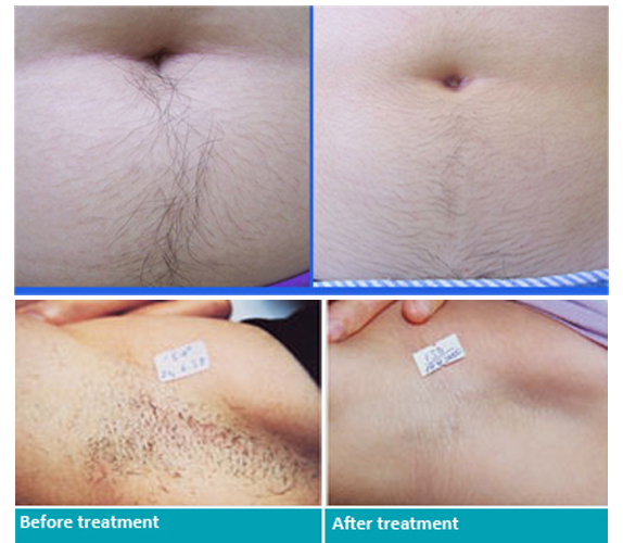 1-10 Hz Permanent Hair Removal Laser / 808 Laser Hair Removal Device 1 Pulse