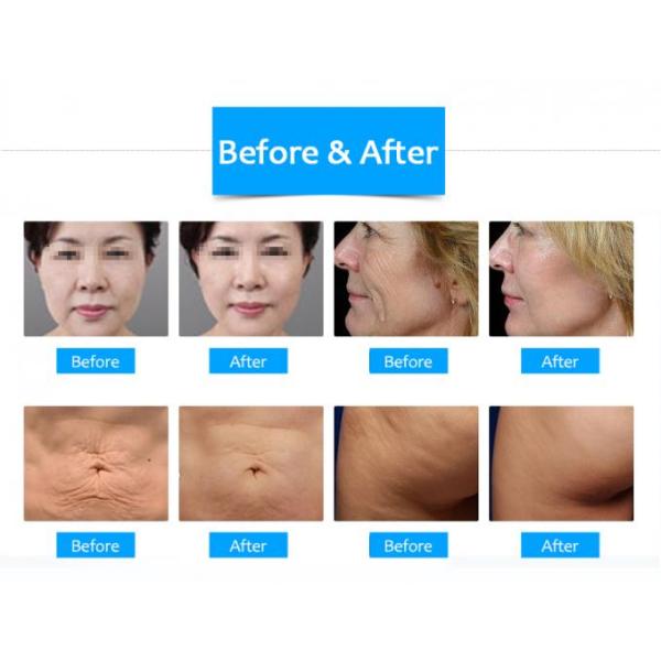 Anti Aging Beauty Salon radio Frequency Machine 100-240V