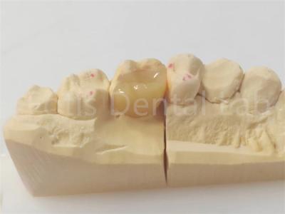 Precision Dental Inlay And Onlay For Accurate And Durable Restorations