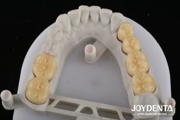 Dentaduras de zirconia que imitan los dientes naturales