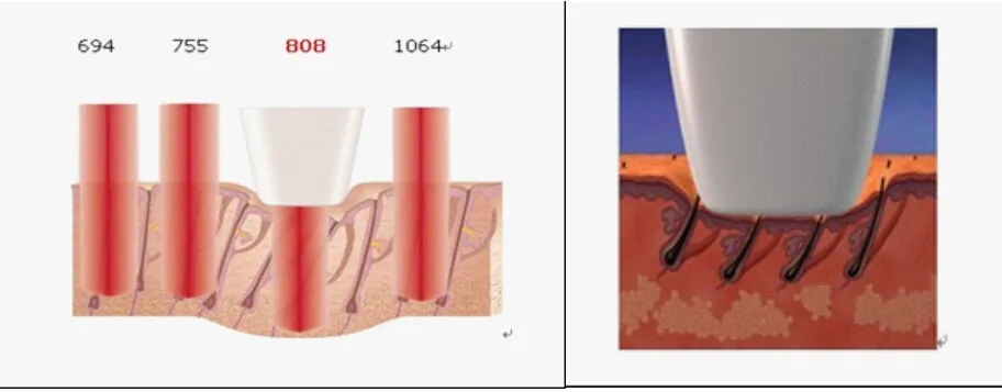 2000W strong power ! Germany bar diode laser hair removal system/ three wavelength 808nm + 755nm + 1064nm