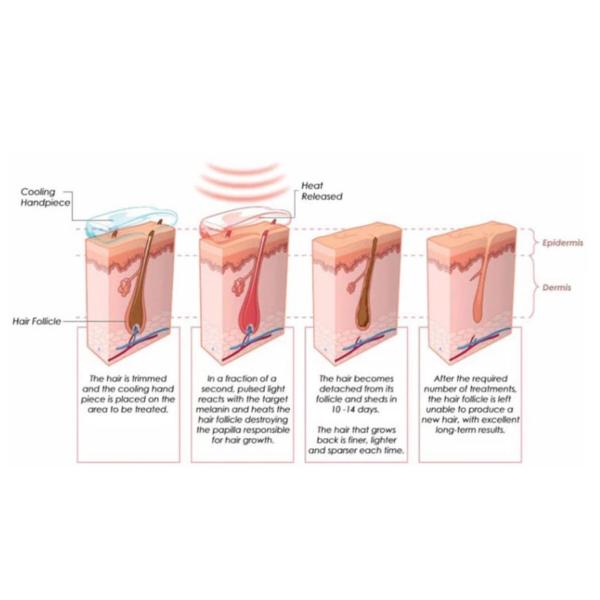 1 - 120J Energy Facial Hair Removal Devices For Hair Removal Treatment