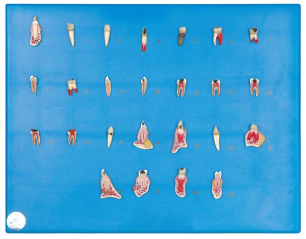 25 Kinds of Dental Disease Series Human Teeth Model for Hospitals , Schools Training