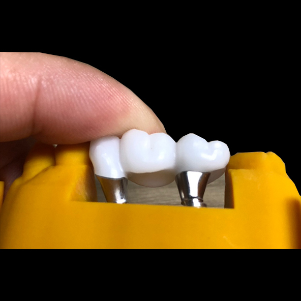 Silver Custom Titanium Abutments Dental Implants With Full Zirconia Crown