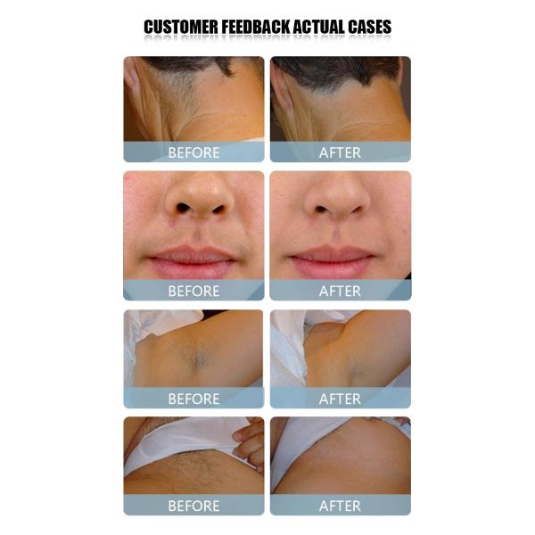 808nm Laser Diode Alexandrite Laser Hair Removal Machine Permanent Painless