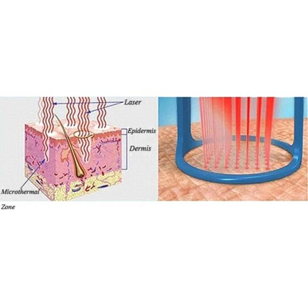 3 In 1 Rf Tube Fractional Co2 Laser Device For Acne Scars Removal Skin Care Machine