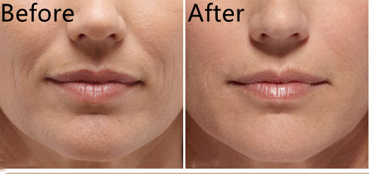 Заполнитель увеличения 5ml Derm впрыски губы дермальный для сыворотки заботы кожи носа Chin