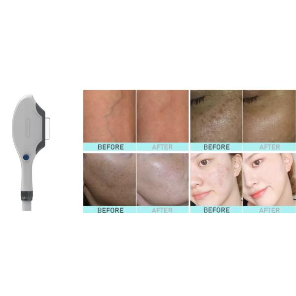 Laser OPT SHR Nd Yag IPL Hair Removal Machine 3 In 1 480nm 530nm For Salon